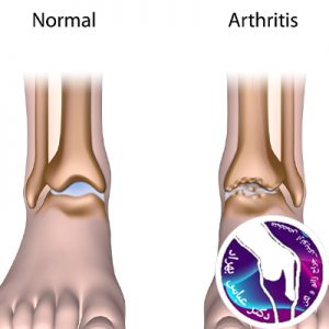 آرتروز مچ پا چیست