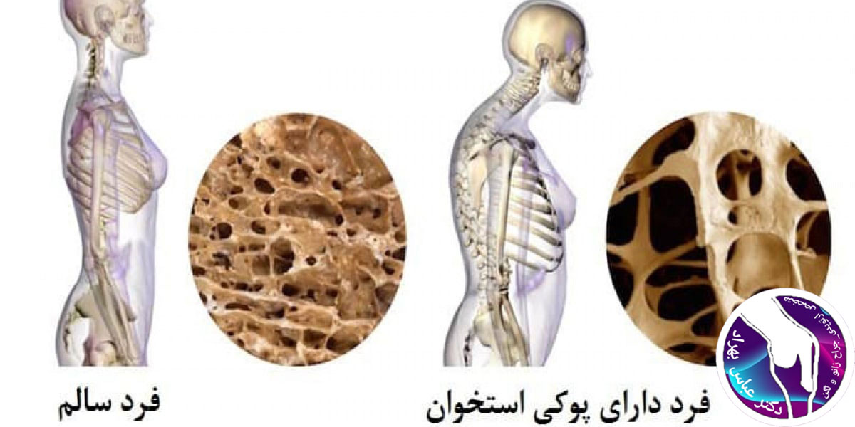 پوکی استخوان در زانو